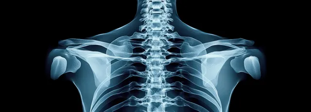 X-ray image shows upper back thoracic spine, ribs, and shoulder blades against a black background.