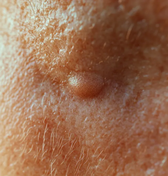Close-up of a raised red swollen bump on human skin showing irritation texture from a wasp sting.