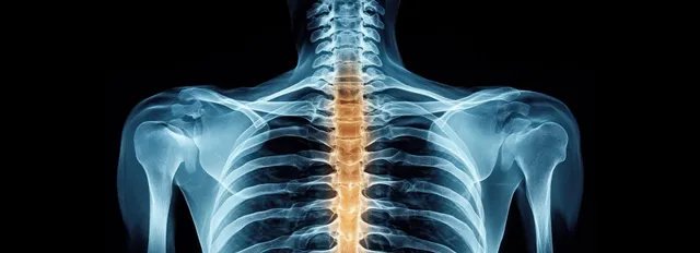 X-ray shows the human upper torso skeleton with the spine and ribcage clearly visible against a dark background.