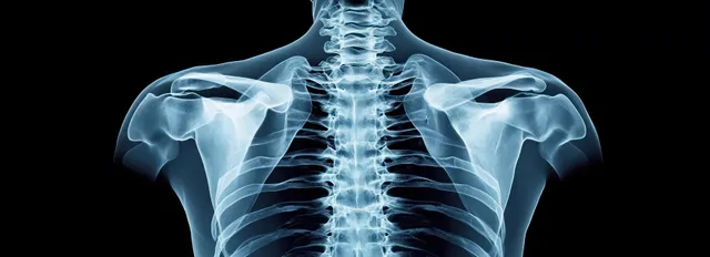 X-ray of the upper back showing the spine, ribs, and shoulder blades on a black background.
